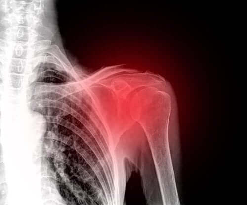 Een röntgenfoto van de schouder