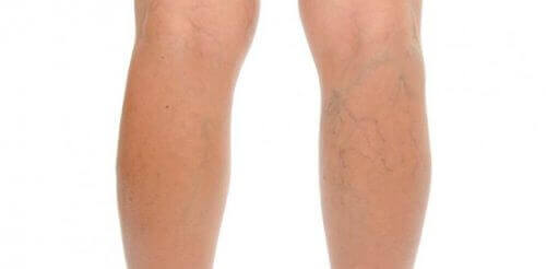 Venoruton kan gebruikt worden tegen spataderen