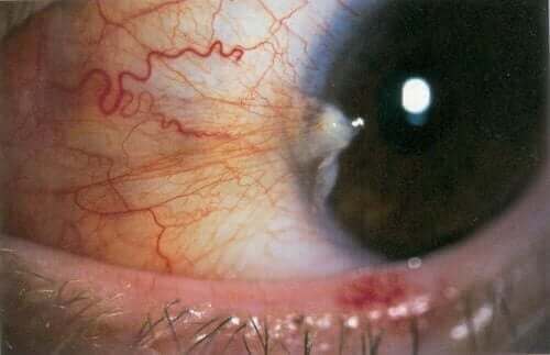 Een aandoening van het bindvlies in het oog
