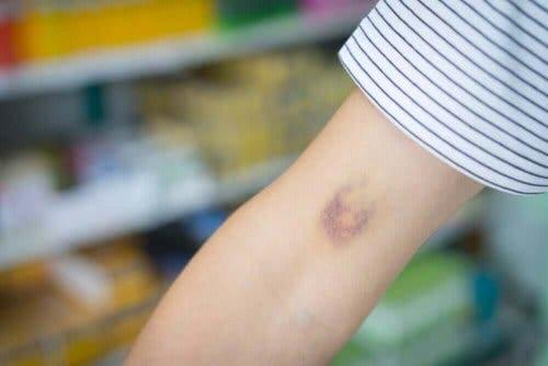 Een persoon met een blauwe plek