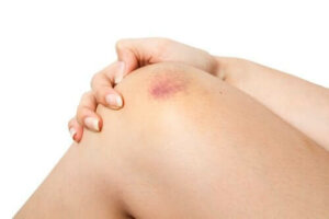 Ecchymose: wat is het precies?