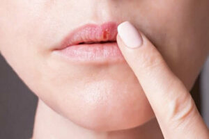 De kenmerken van het herpes-simplexvirus