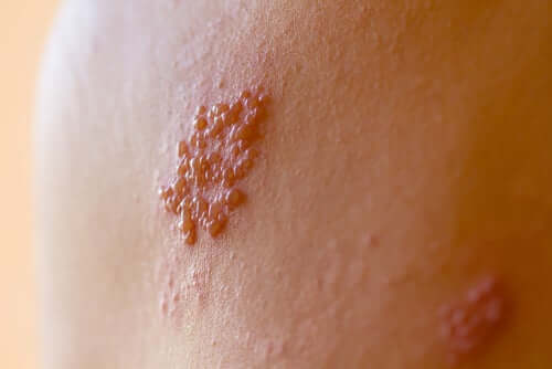 Close-up van herpesblaasjes op de huid