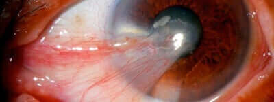 Pterygium in het oog