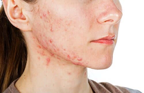 Een jonge vrouw met acne