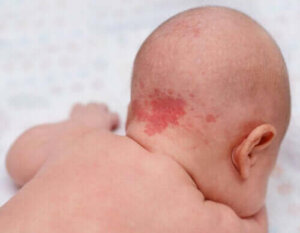 Geboortevlekken en moedervlekken: waarom verschijnen ze?