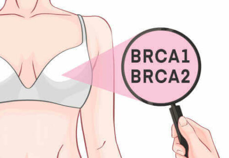 De genen BRCA1 en BRCA2 en borstkanker