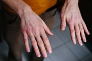 Droge en gebarsten handen: bescherming tegen de kou