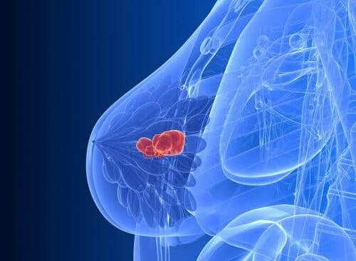 Tumor in borst