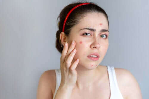 De beste behandelingen tegen acne om te proberen