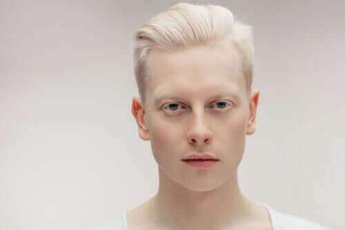Leer vandaag alles over albinisme