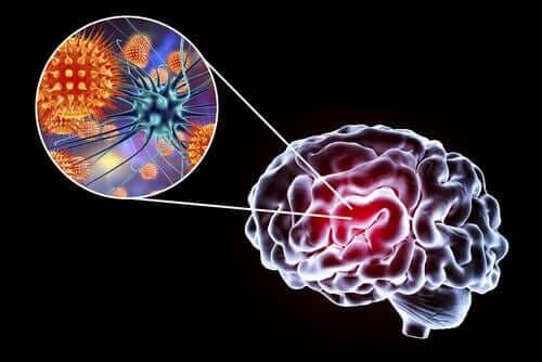 Encefalitis: symptomen, oorzaken en behandeling