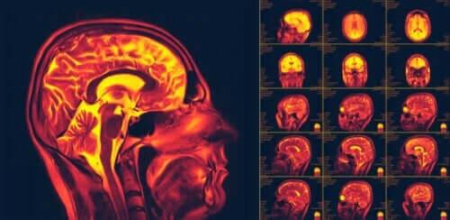 Wat is neuroplasticiteit in de hersenen?