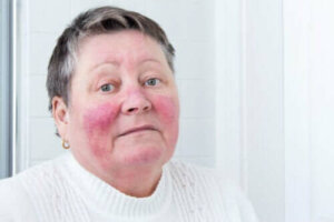Oorzaken en symptomen van rosacea