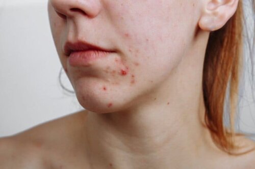 Acne op de huid