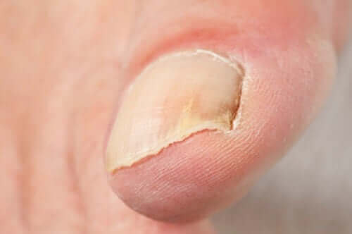 Een close-up van een schimmelnagel