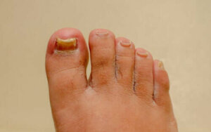 Werken middelen tegen onychomycose echt?