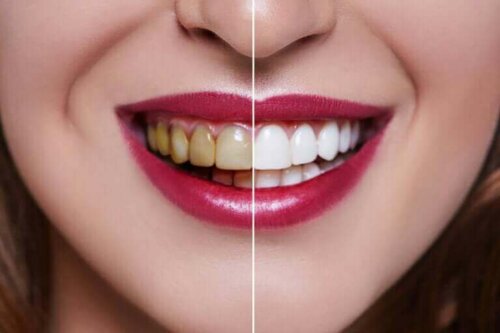 Een vrouw met aan de ene kant gele tanden en aan de andere kant witte tanden