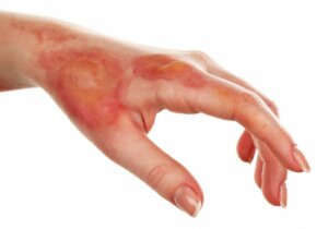 Alles over de diagnose van huidnecrose