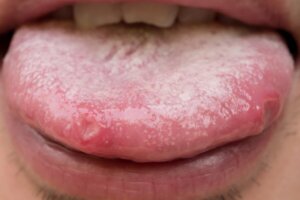 Natuurlijke remedies tegen orale candidiasis