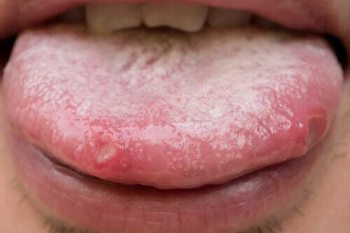 Natuurlijke remedies tegen orale candidiasis
