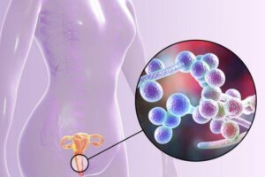 Test voor een schimmelinfectie - ontdek er alles over