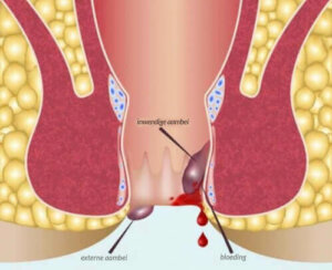 Anoscopie: een overzicht van de procedure