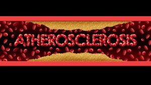 Symptomen en behandeling van atherosclerose