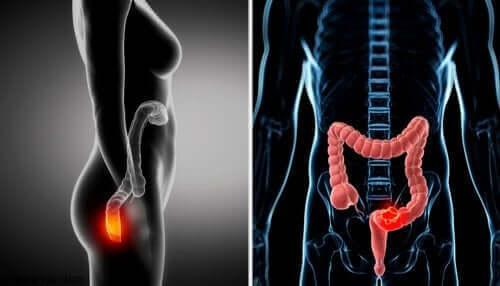 Voor wie is een anoscopie