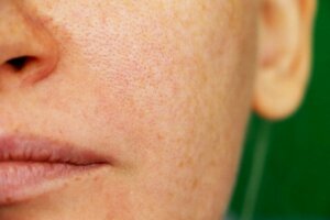 Drie natuurlijke remedies voor melasma