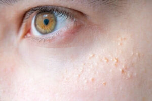 Natuurlijke remedies voor keratosis pilaris