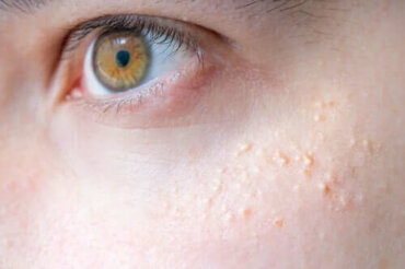 Natuurlijke remedies voor keratosis pilaris