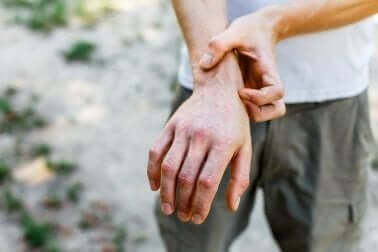 Hand met bultjes