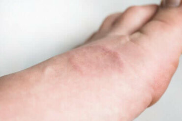 Wat is granuloma annulare eigenlijk?