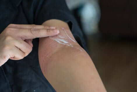 corticosteroïden op de huid van de arm aanbrengen