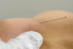 Wat is dry needling en is het effectief?