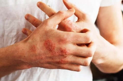 Psoriasis op de handen