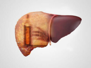 Alcoholische hepatitis: leer er hier alles over