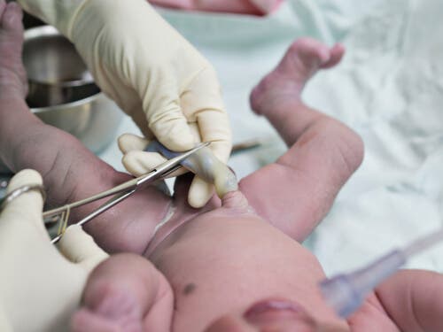 Een arts knipt de navelstreng van de baby door