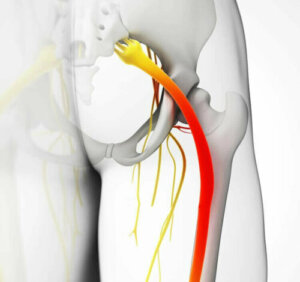 5 manieren om symptomen van ischias te verlichten