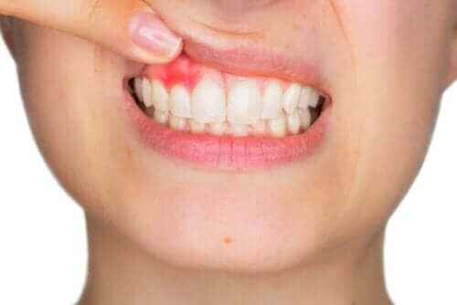 Het gebruik van hyaluronzuur in de tandheelkunde zoals bijvoorbeeld bij tandvleesontstekingen