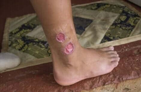 Een been met cutane leishmaniasis