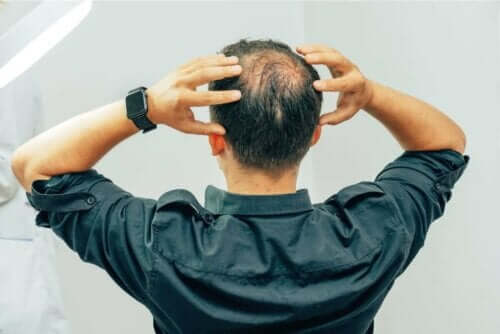 Een man met alopecia grijpt zijn hoofd vast