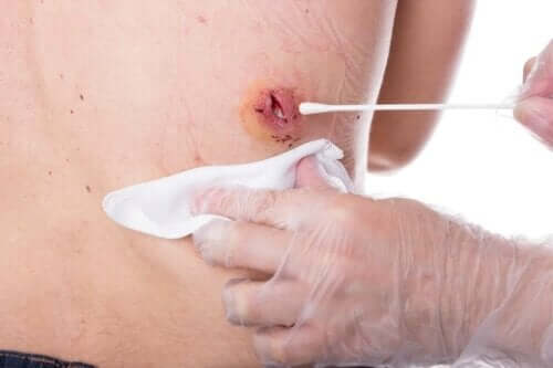 Een verpleegster die een huidwond behandelt