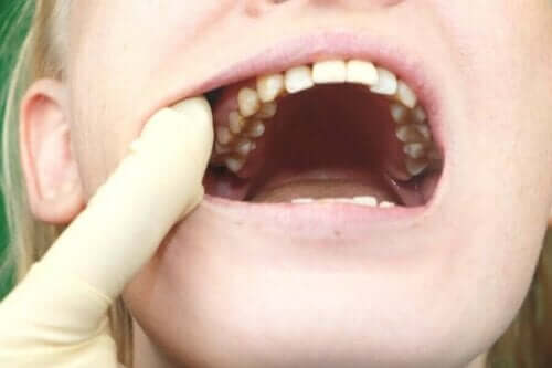Tanden met gaatjes