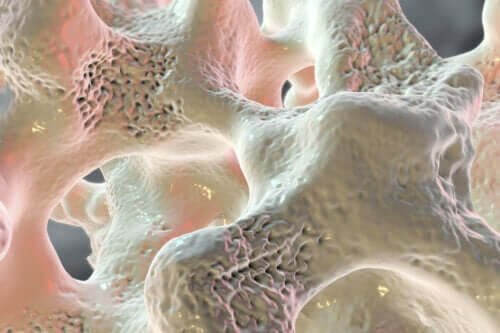 Osteoporose bij diabetes