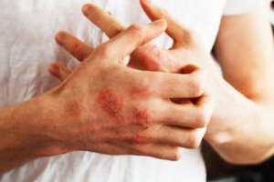 Psoriasis onder controle houden door je dieet