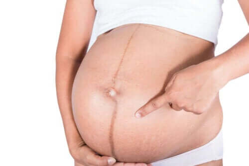 Huidveranderingen tijdens de zwangerschap