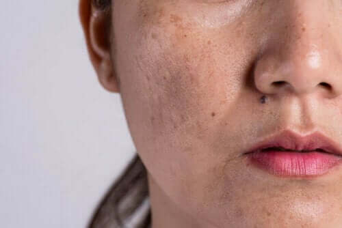 Vrouw met huidveranderingen in het gezicht