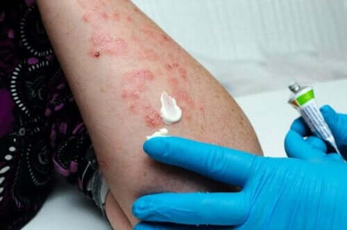 Zalf voor herpes zoster